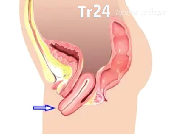 Rahim sarkması ve tedavi yöntemleri nelerdir?