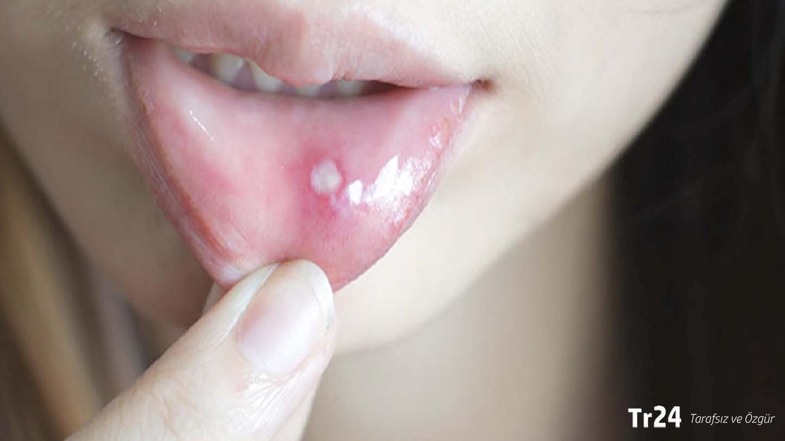 Uzmanlar uyarıyor: Ağız yaraları 3 haftadan uzun sürüyorsa dikkat!